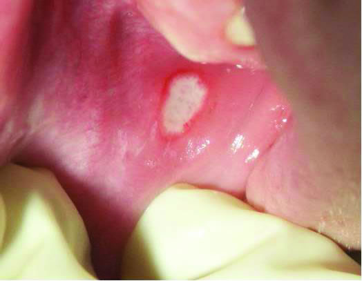 canker_sore_picture504x407